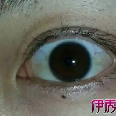 两岁半宝宝今天眼白发黄是怎麼回事,类似下图