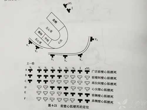 以下定位图只适用于"st段升高型心肌梗死"