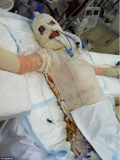 女子被情敌报复全身烧伤,历经两百多次手术微笑生活