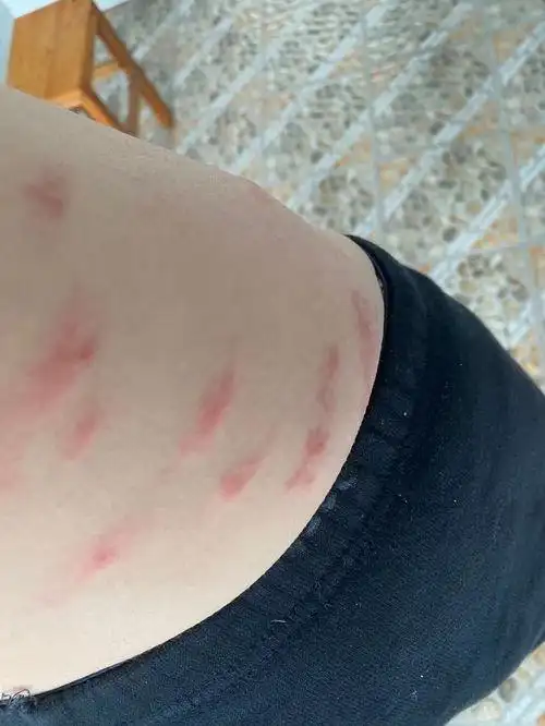 被蟑螂咬过的皮肤图片 - 搜狗图片搜索