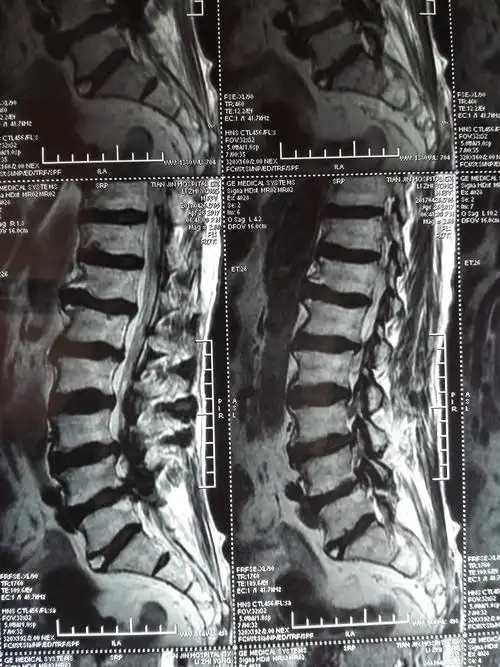 重度腰椎管狭窄可单病种管理详见文末
