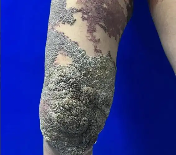 女孩身上长出大片"菜花",竟然是疣状静脉畸形