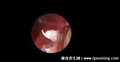 尖锐湿尤图症状图片男,警惕菜花样小疙瘩和假性湿疣区分 — 神奇养生