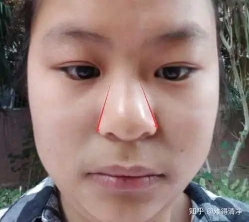 这是哪类鼻型的鼻子?