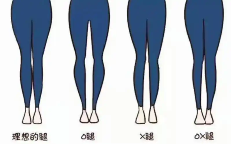 xo腿型纠正训练