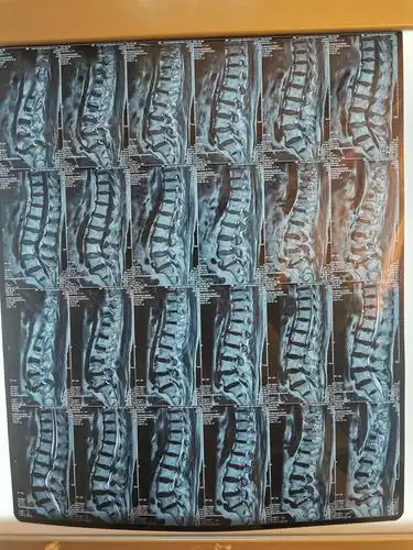 内蒙古民族大学附属医院西医骨二科腰间盘突出个体化治疗!