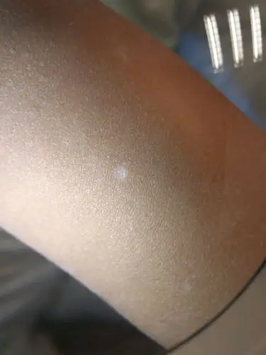 今天的这位小患者,在面部,上肢,出现多发的色素脱失斑,局部还带有凹陷