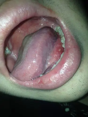 舌头上那个白的是啥