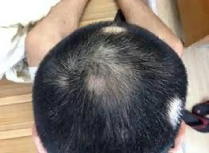 溢脂性脱发的图片