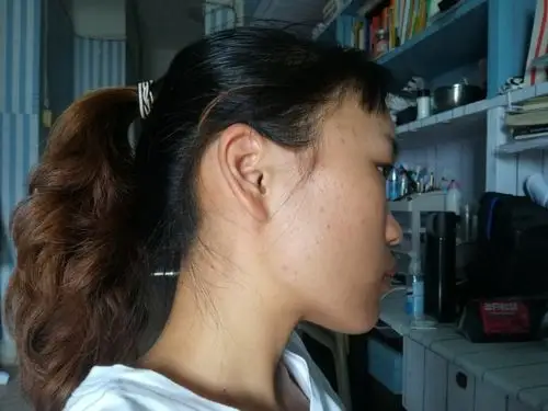 脸歪,以为脸歪是牙齿咬合不正,后来看了牙医,说挺正常的,还有一妇就