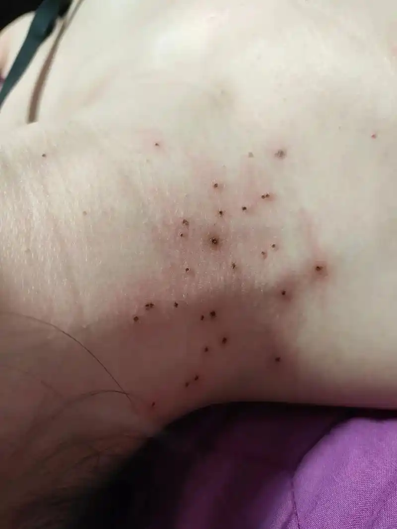 皮肤赘生物丝状疣一次性祛除