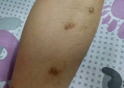 夫妻2人同时感染hpv,医生:身上长这些"疙瘩" 都该查查|病毒|宫颈|出血