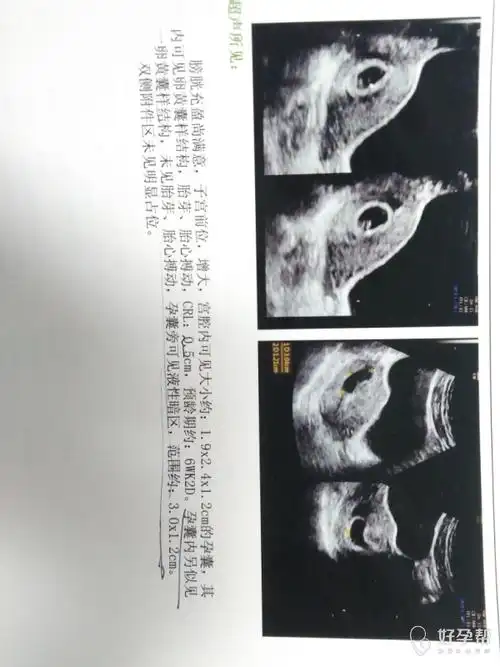 怀孕50天b超检查出双孕囊