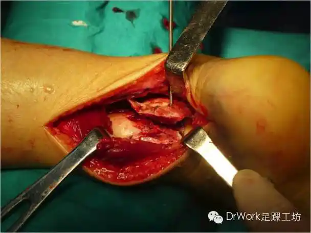 克氏针临时固定