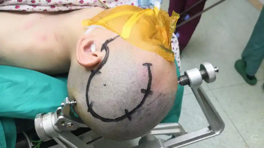 采用经左侧颞下沟前部的入路1,肿瘤位于左侧颞叶深部,手术目标是在