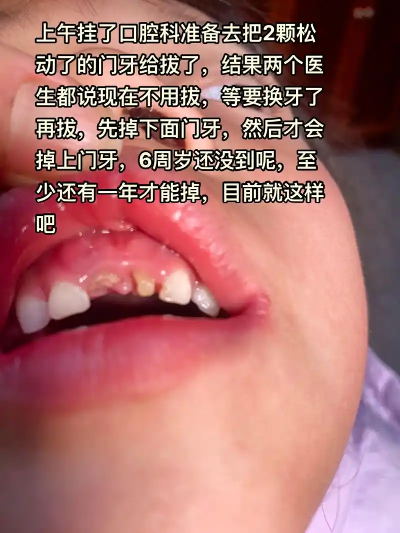大门牙不用拔,磨牙要补.一次性补了3颗磨牙,虽说这3颗磨牙是 - 抖音
