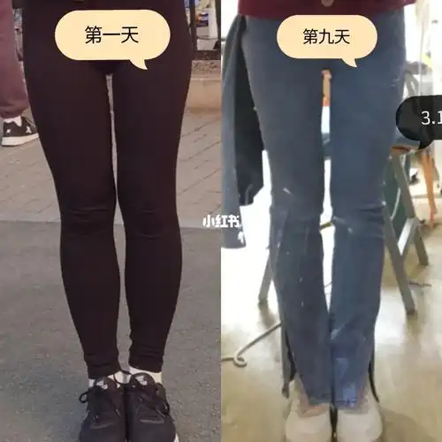 小腿外翻77大腿前侧突出