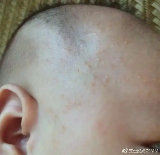 宝宝长痱子这样护理简单又好的快