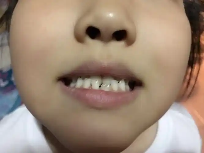 现在是换牙期,左下门牙已经长出新牙,右下门牙也已经开始萌出,乳牙还