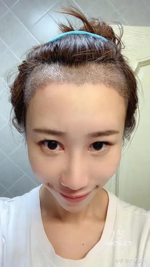 关于女生植发那些事儿11月4日我去植了发际线