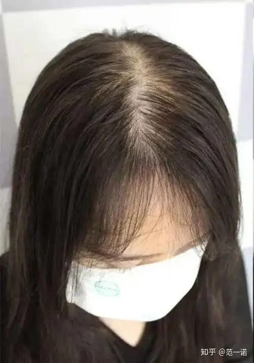 口碑!女生头顶头发稀少"落落大方"-第1张图片-康峰博客