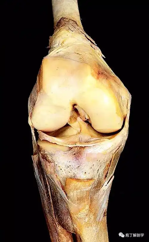 滑膜襞和滑膜囊有些关节囊的滑膜表面积大于纤维层,滑膜重叠卷折并