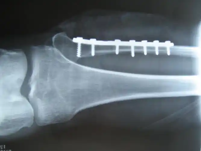 腓骨近端骨折的上了个钢板