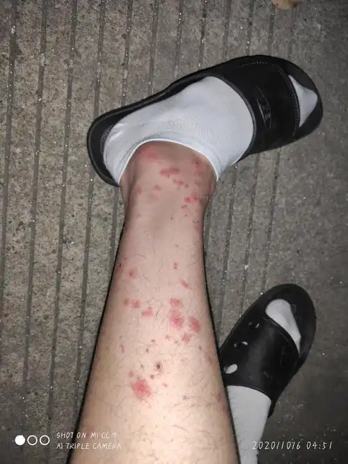 被跳蚤咬的全身都是包是什么样的感受! - 知乎