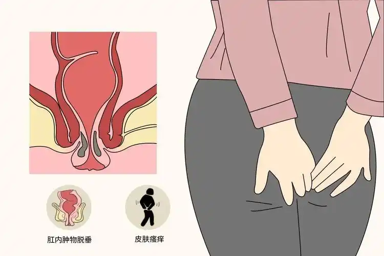 肛门脱垂图片