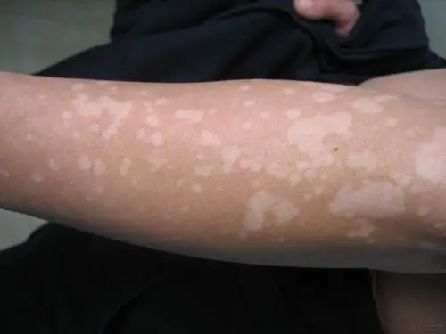 看看漂亮的花斑癣