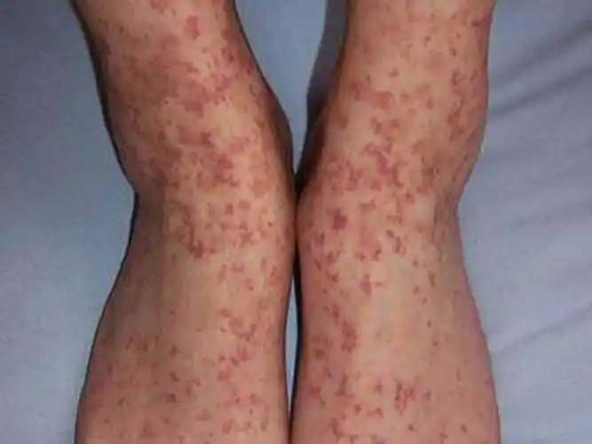 皮肤病的种类图片大全红斑图片