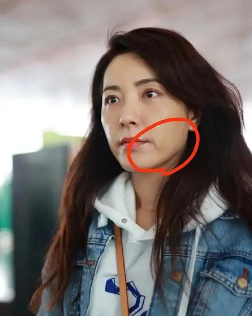 拍照时嘴角肌肉严重下垂,需要去除口角囊,看医美怎么做?