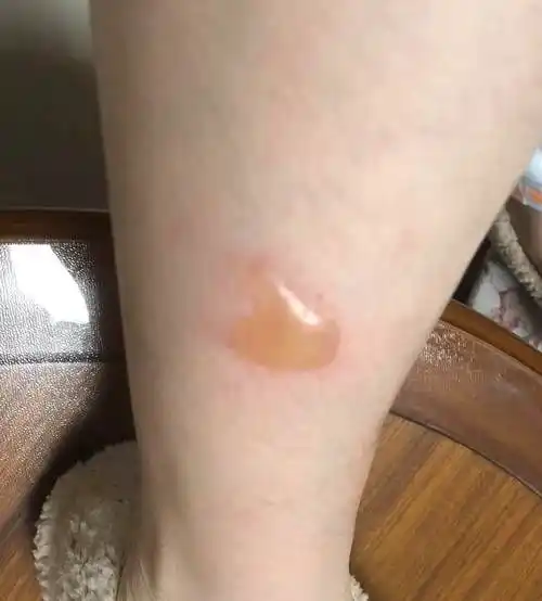 50热水袋烫伤引起的水泡比100开水烫伤难治并且是无药可治