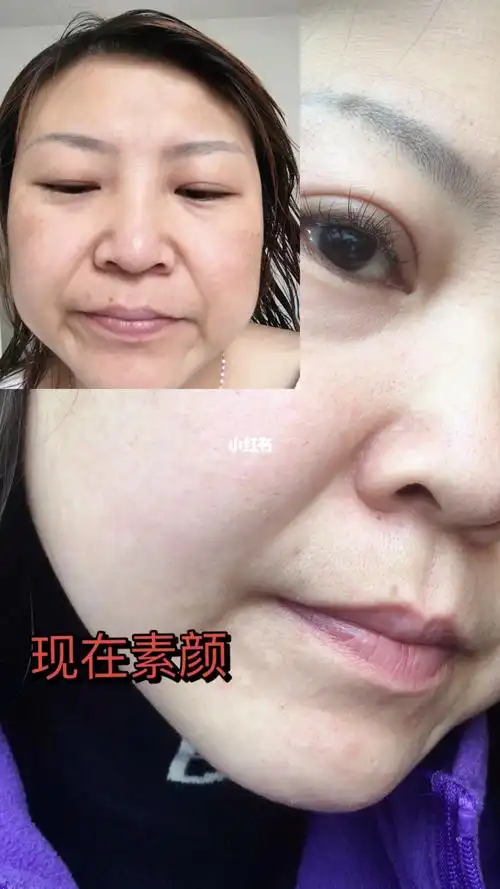 没有对比就没有伤害,真不敢回头看原来的自己,黄脸婆,困扰多年的黄褐