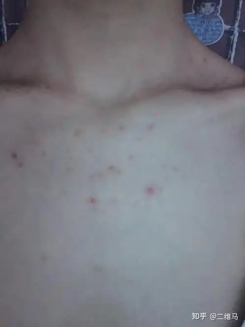 胸前长这样的痘痘而且越来越严重是怎么回事啊怎么解决