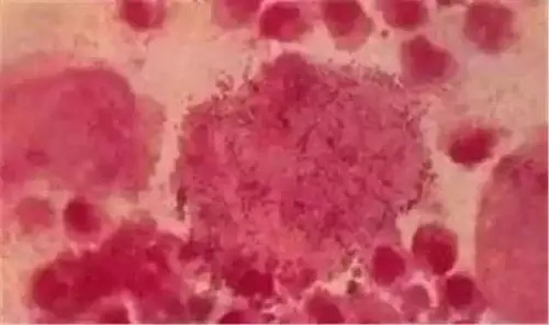 女性外阴长了很多小疙瘩,是不是`性病`?