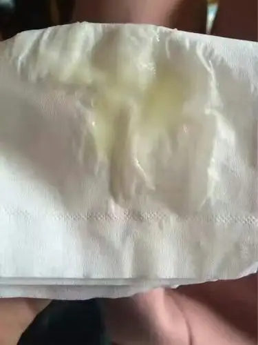 黄色水样白带』 症状:色黄,白带清澈如水,常湿透内裤,有一股臭味,由