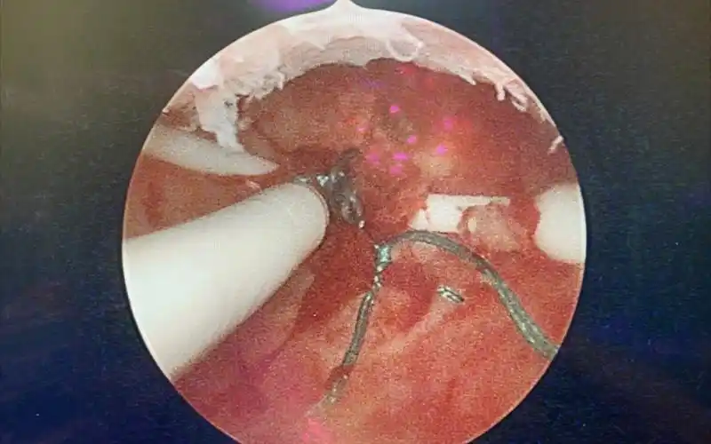 宫腔镜曼月乐缝合固定术"是环下移或脱落患者的补救措施,让子宫腺肌症