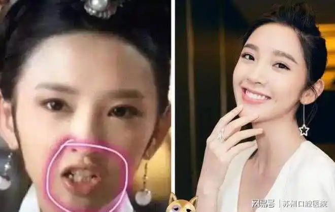 女明星"整容"内幕曝光:你的牙齿,暴露了行业规则|口腔|口腔健康|牙套