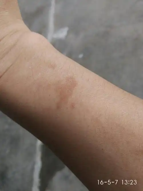 手臂上长出一块一块的褐色斑块,是病吗,怎么解决