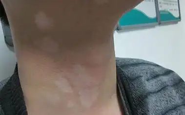 脖子上有白斑点出现——小心是白癜风脖子上出现了白斑点,要考虑是