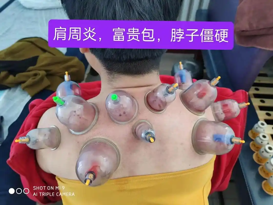 益康灸.肩周炎,富贵包,手麻,穿衣服都困难,推拿 拔罐 药灸 - 抖音