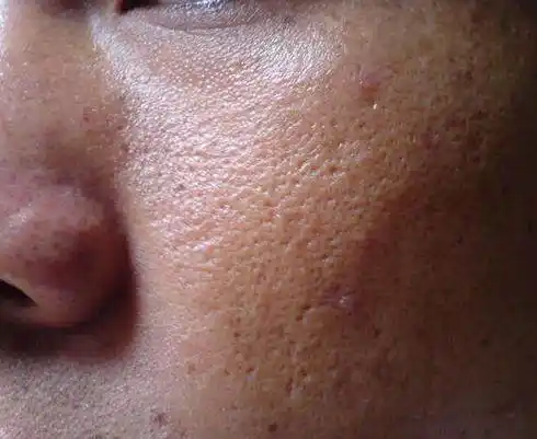 皮肤粗糙:湿气重则脾胃的运化功能较差,水湿在体内停滞会影响皮肤