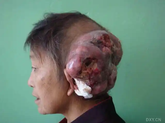 【讨论】已侵蚀颅骨的头枕部巨大肿瘤 [精华] [病例帖]