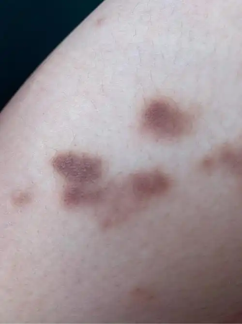 皮肤上面的黑色斑块是淋巴瘤吗