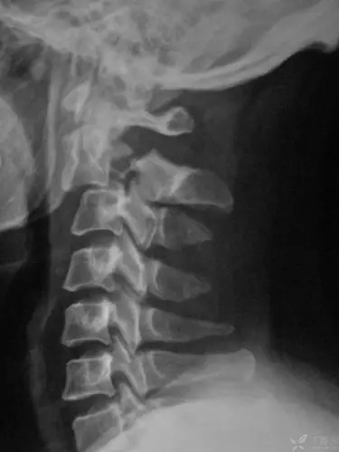 颈椎骨折,前路还是前后联合,怎么考虑? [病例帖]