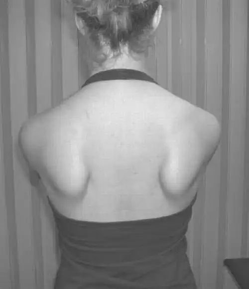 出拳无力原来和肩胛骨有关