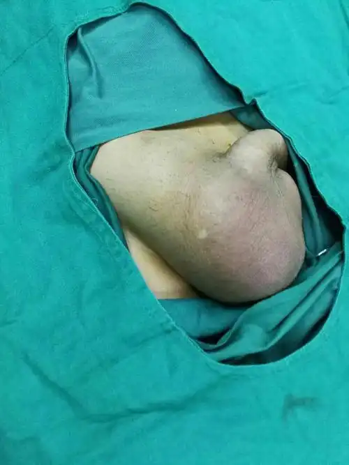 术前肿大的阴囊