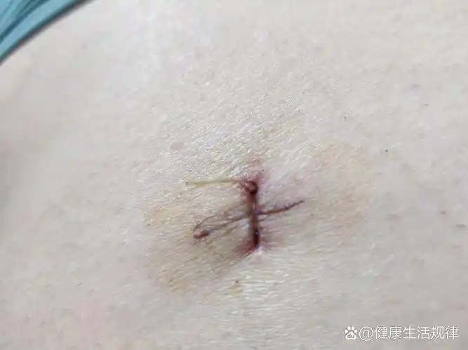 阑尾炎手术后7天的伤口