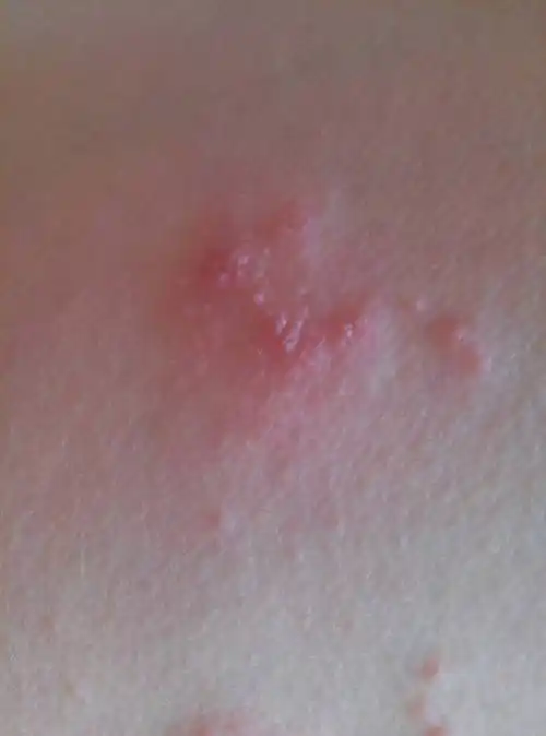不痛不痒,大腿内侧两侧,4天了,还在新发,这是什么皮肤病?